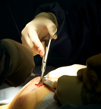 Implant-Based Breast Reconstruction