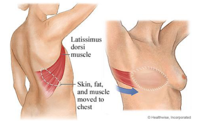 Breast Reconstruction