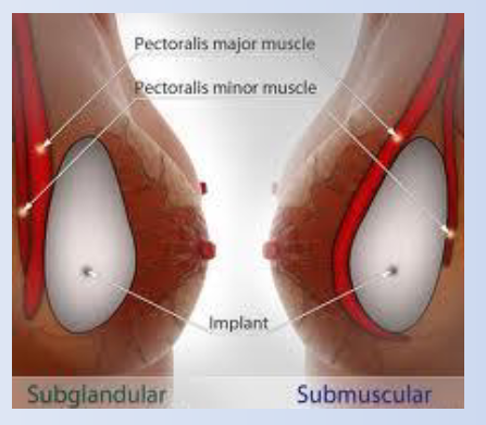Breast Augmentation