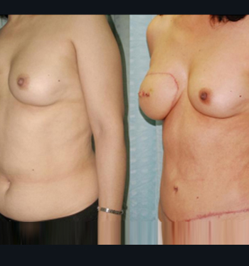 Reconstruction After Breast